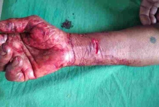 Bibatya attack a woman in Sangamner taluka, woman injured