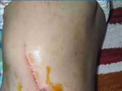 Dogs attack children playing in Sangamner