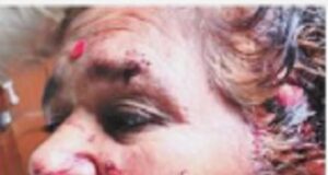 Two children rescue mother from bibatya attack